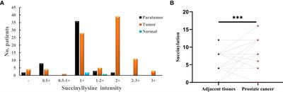 The involvement of high succinylation modification in the development of prostate cancer